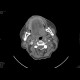 Carcinoma of the tongue: CT - Computed tomography